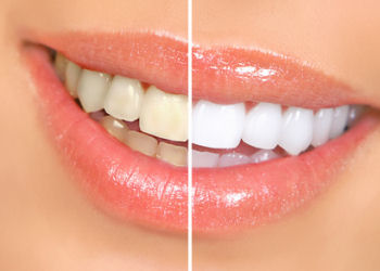 Teeth whitening Gold Coast